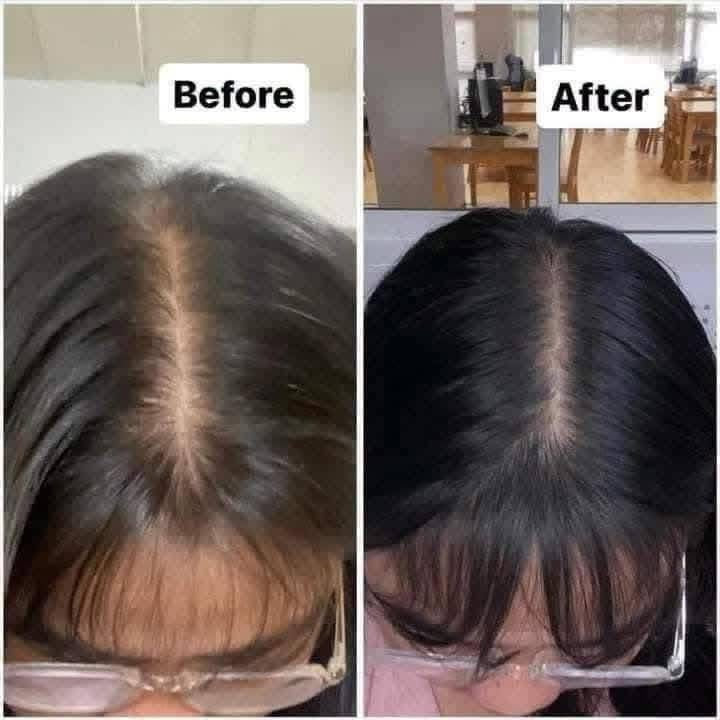 ရှမ်းမစျေးခြင်း - hair tonic 100 ml